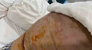 Beyoğlu'nda barda yanan genç kız dehşet anlarını anlattı: "Bir anda alev topuna döndüm"