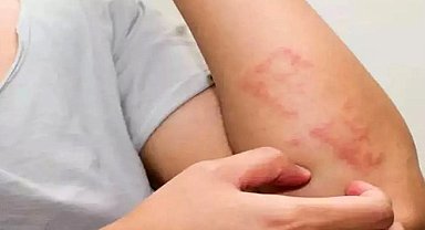 Bu iki kavramı karıştırmayın, besin alerjisi mi besin intoleransı mı