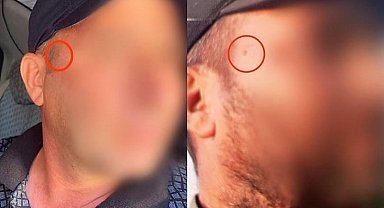 Jandarma korkusundan yüzündeki beni aldırdı