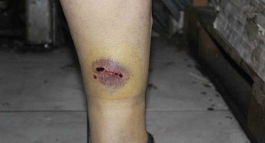 Sokak köpeğinin saldırdığı vatandaş yaralandı