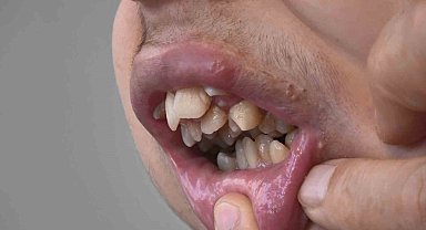 Alt çenesi yok, dişleri üst damağında: Ameliyat için yardım bekliyor