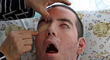 Görme bozukluğuyla başladı, 10 yıldır gözlerini kapatamıyor