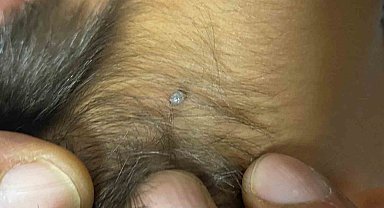 Konya'da 4 yaşındaki çocuğa kene yapıştı