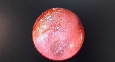 Kulağından canlı örümcek çıktı