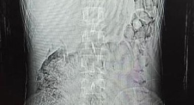 Midesinden 78 kapsül uyuşturucu çıktı