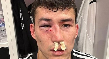 Beşiktaş: "Zaynutdinov'un burnunda ve göz çukurunda kırık saptanmıştır"