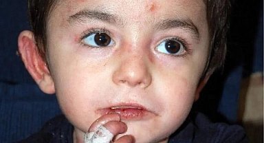 13 yaşındaki Mert, kelebek hastalığından öldü