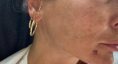 Bursa'da 6 ayda, 6 bin 537 kadın ve 755 erkek eşlerinden şiddet gördü