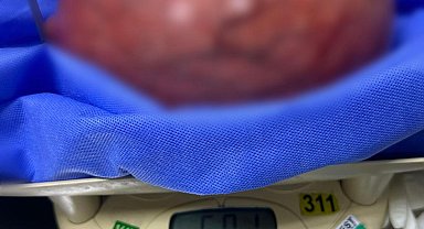 Kilo aldığını sandı, rahminden 5,5 kilo kitle çıktı