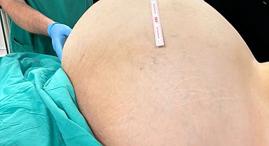 İstanbul - Yumurtalıklarındaki 23 kiloluk kitle operasyonla çıkarıldı; doktorlar da şaşırdı