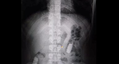 Midesinde taşıdığı 1 kilo uyuşturucuyla yakalandı