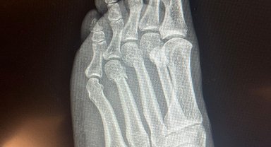 Özgür Özel'den, 'ayağından vuruldu' iddialarına röntgenli yanıt