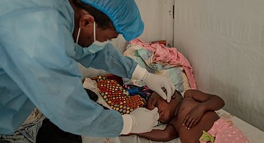 USAID, maymun çiçeğinden etkilenen bölgelere 35 milyon dolarlık yardım sağlayacak