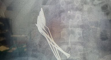 15 yaşındaki çocuğun midesinden 4 kaşık ve 1 çivi çıkarıldı