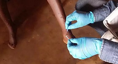 Kongo'da maymun çiçeğine karşı aşılama başladı