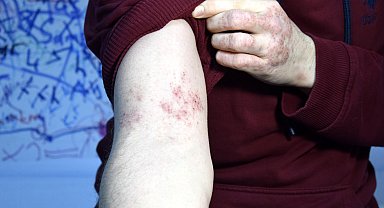 'Egzama artık modern yöntemlerle tedavi edilebilir bir hastalık'