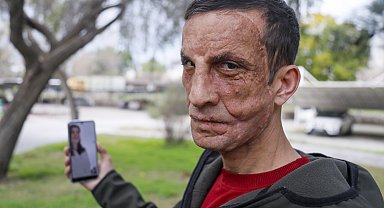 Babasının yüzünün nakledildiği Uğur'la duygulandıran görüşme