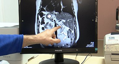 Bütün iç organları ters yerde; karın ağrısı şikayetinden dünyada yapılan 47'nci işlemle kurtuldu