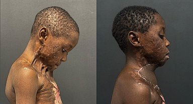 Oyun oynarken yanan Kamerunlu çocuk, 7 saatlik operasyonla sağlığına kavuştu