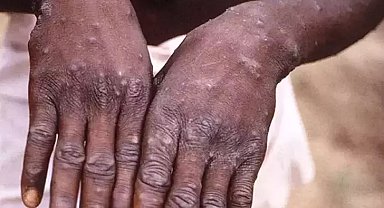 Sierra Leone'de Maymun çiçeği vakaları nedeniyle 'acil durum' ilan edildi