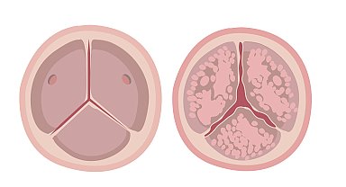 Uzmanı uyardı: Nefes darlığı ve çarpıntı kalp kapaklarındaki sorunun belirtisi olabilir