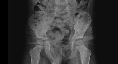 5 yaşındaki çocuğun yuttuğu toplu iğne, ameliyatla çıkarıldı