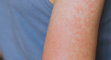 ABD'nin Teksas eyaletinde 48 kızamık vakası bildirildi