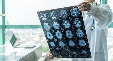 Araştırma: Bunamanın ilk belirtisi 11 yıl önce ortaya çıkıyor