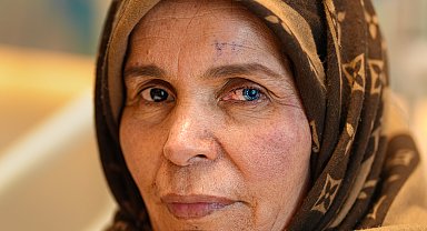 Kornea nakli geçiren Libyalı kadın, iki farklı göz rengine sahip oldu