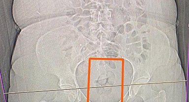 Midesinden 21,39 gram metamfetamin çıktı