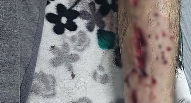 Sokak köpeğinin saldırısına uğradı, bacağına 25 dikiş atıldı