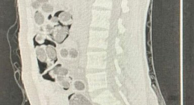 Yabancı uyruklu yolcunun midesinden 219 paket uyuşturucu çıktı