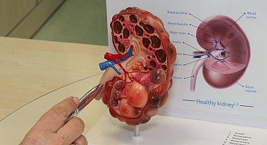 'Böbrek hastalıkları sessizce ilerliyor: Erken teşhis için düzenli kontrol hayat kurtarıyor'