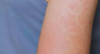 ABD'nin Kansas eyaletinde 23 kızamık vakası bildirildi