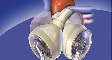 Avustralyalı hasta yapay kalple 100 gün hayatta kaldı