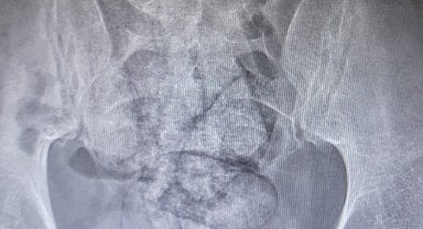 İranlı şüphelinin bağırsağından uyuşturucu çıktı