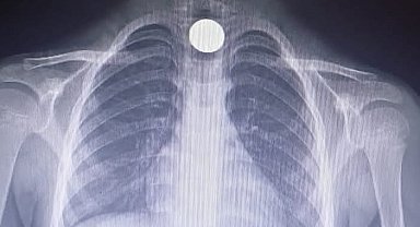 Yusuf'un yemek borusuna takılan madeni para operasyonla çıkartıldı