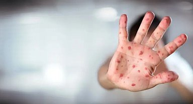 ABD'nin Texas eyaletindeki kızamık salgınında vaka sayısı 624'e yükseldi