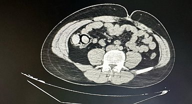 Midelerinde uyuşturucu çıkan 2 şüpheli, tutuklandı