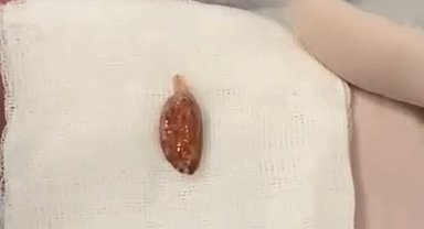 Muhammed bebeğin yemek borusuna takılan badem şekeri, operasyonla çıkarıldı