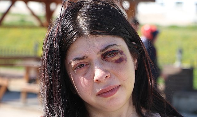 Sokak ortasında darbedilen Damla: Platinler hep yüzümde kalacakmış