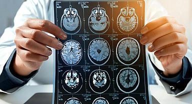 Harvard’dan çarpıcı yeni araştırma: Alzheimer tedavisine karşı yeni umut! Uzmanlar: 